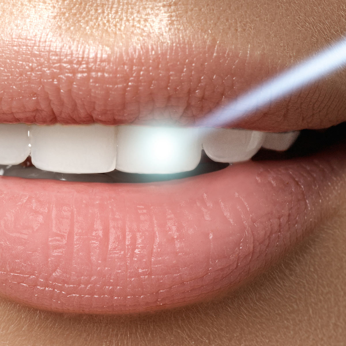 Laserbleaching für Zähne